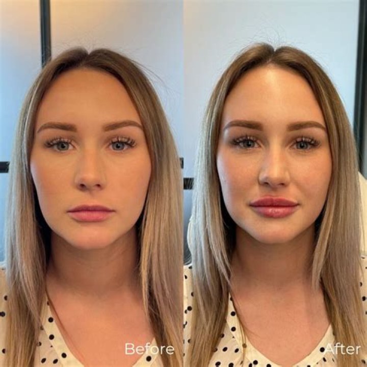 Brielle Biermann, 22, Reveals She’s ‘Dissolving’ Dramatic Lip Fillers & Is Going To Look ’18’ Again